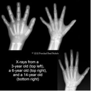 x-rays of children's hands